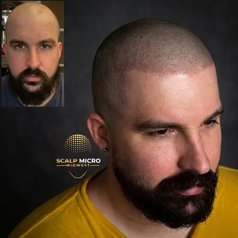 Scalp micropigmentation before and after — hairline restoration