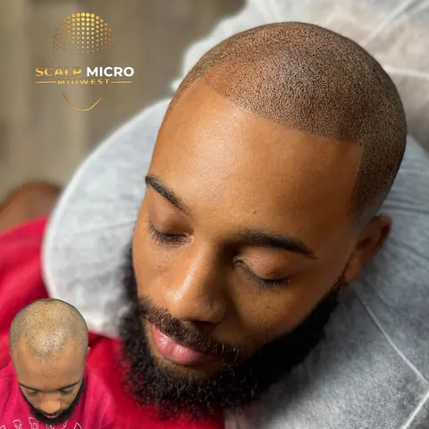 Scalp micropigmentation before and after — density