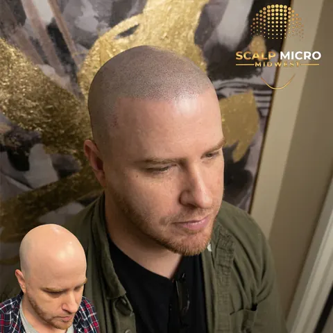 Scalp micropigmentation before and after — receding hairline