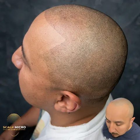 Scalp micropigmentation before and after