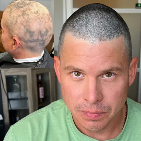 Scalp micropigmentation before and after