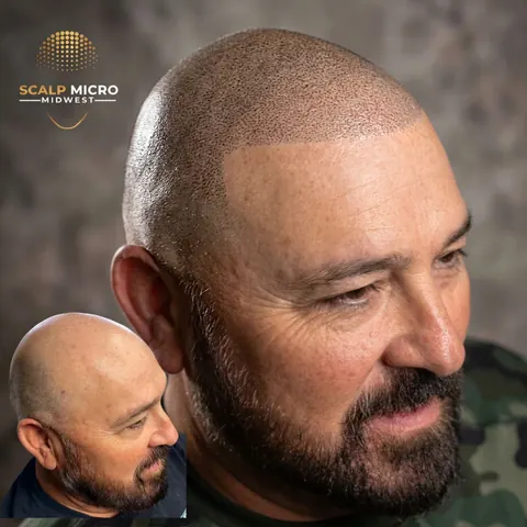 Scalp micropigmentation before and after