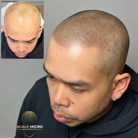 Scalp micropigmentation before and after