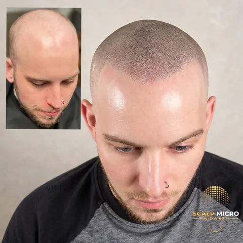 Scalp micropigmentation before and after