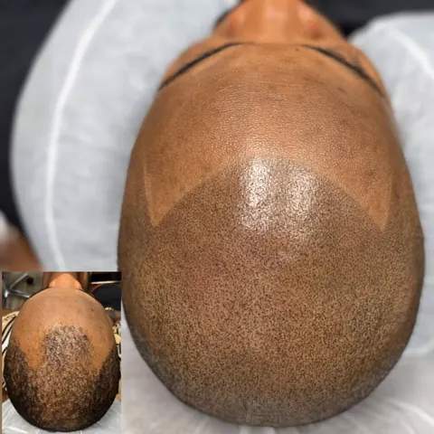 Scalp micropigmentation hairline close-up