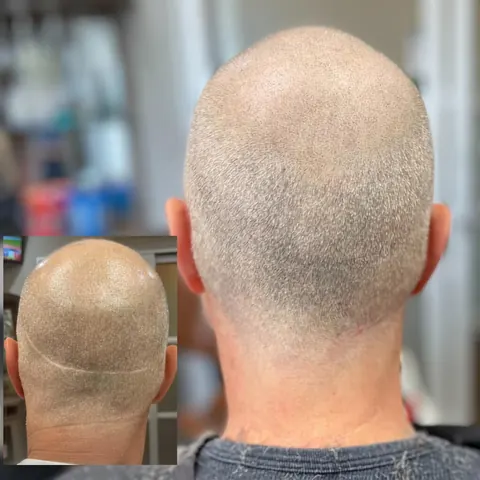Scalp micropigmentation back of head before and after