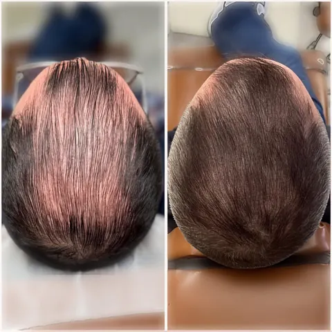 Scalp micropigmentation for female thinning — before and after
